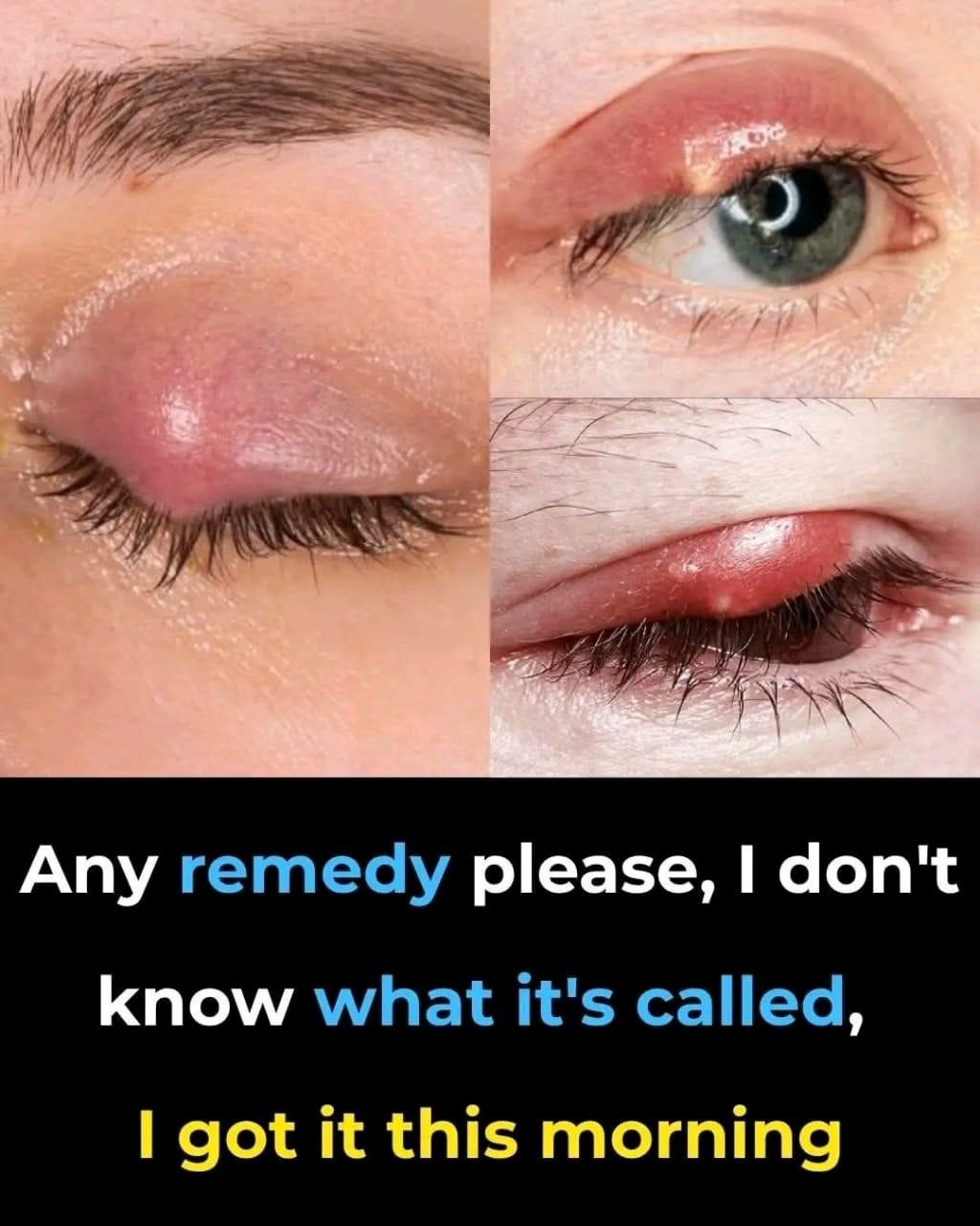 Any remedy please, I don’t know what it’s called, I got it this morning