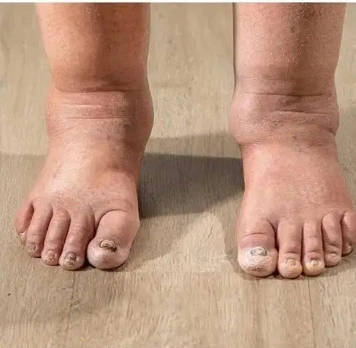 Swelling in the Ankles in the Evening Can Be a Warning Sign of…
