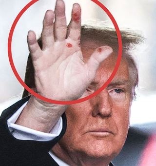 Are Donald Trump’s Mysterious Red Spots Due to Excessive Golf or a Health Issue?