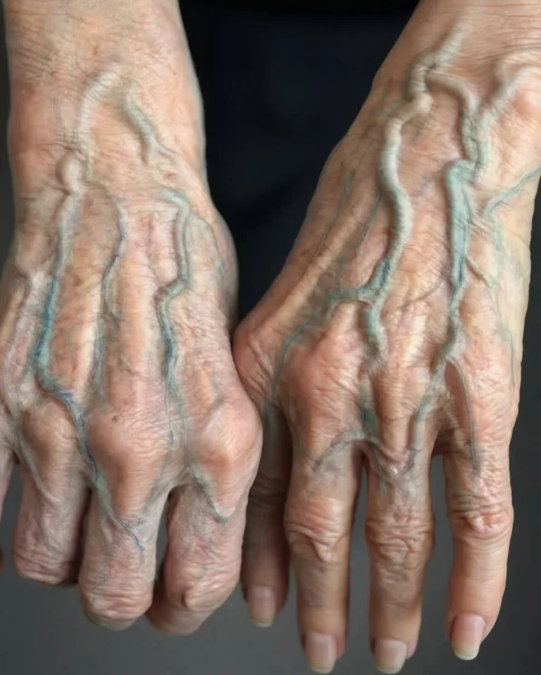 If your veins are visible in your hand, it is a signal of ca… See more