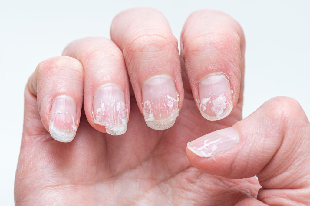 Weak or Brittle Nails: What Your Body Is Trying to Tell You