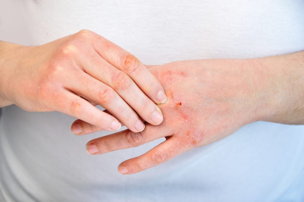 Atopic dermatitis (eczema): causes, symptoms, treatments and medications
