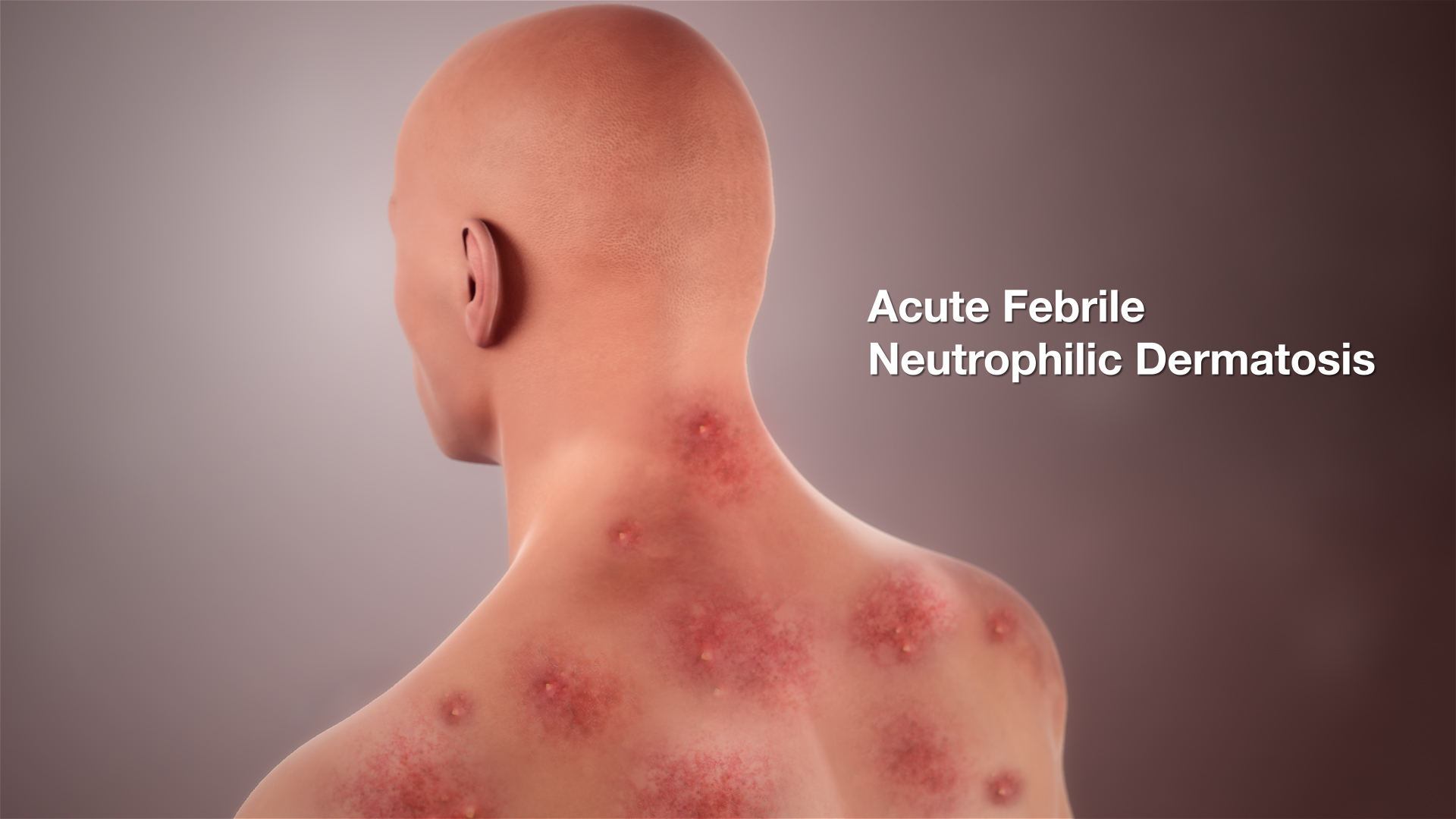 Acute febrile neutrophilic dermatosis shown by a medical animation image