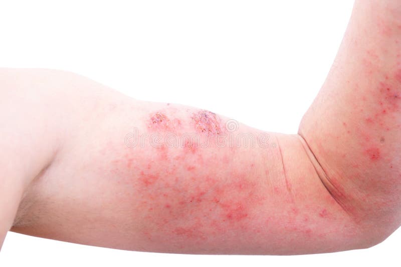 1,349 stock images of foot eczema - Free and royalty-free stock images from Dreamstime