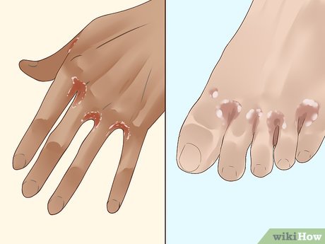 3 Ways to Spot the Symptoms of Diabetes - wikiHow Health