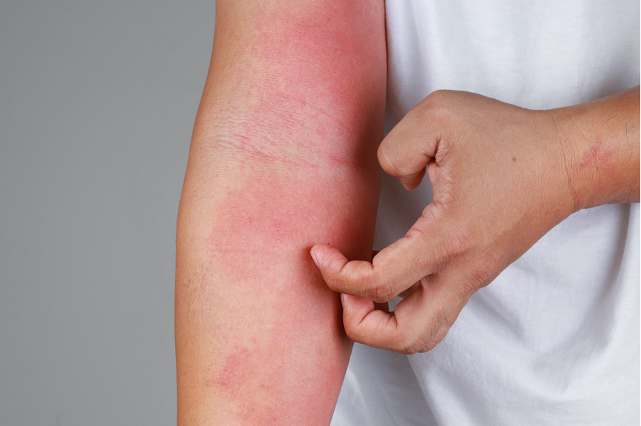 What is atopic dermatitis? Causes and treatment? – Dermalogica Vietnam